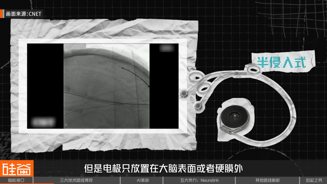 脑机接口大盘点：从科幻到现实，谁在引领这场“读心术”革命？