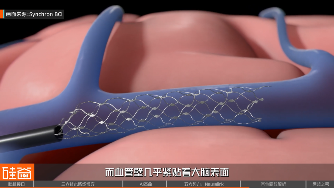 脑机接口大盘点：从科幻到现实，谁在引领这场“读心术”革命？