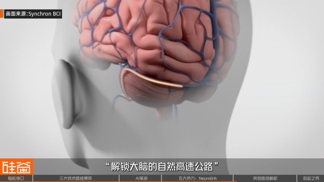 脑机接口大盘点：从科幻到现实，谁在引领这场“读心术”革命？